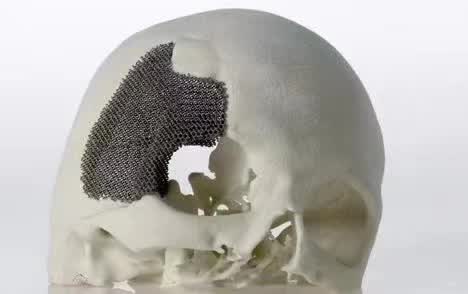 顱骨3D打印技術(shù)是什么？